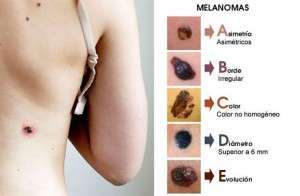 abc_melanoma