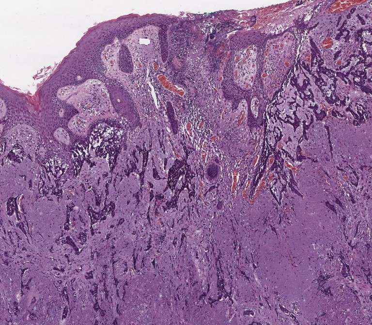 ¿Qué es el carcinoma basocelular y por qué debes conocerlo? - Clínica ...