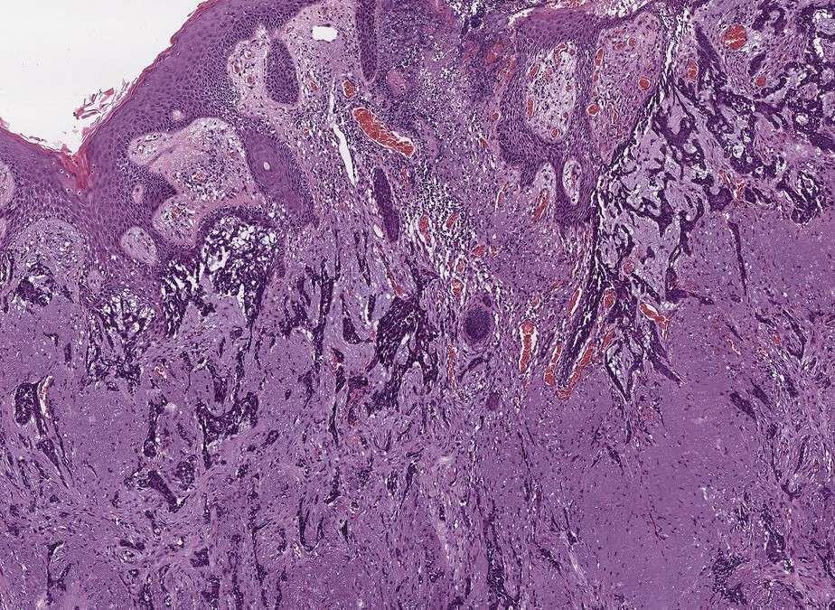¿Qué es el carcinoma basocelular y por qué debes conocerlo?