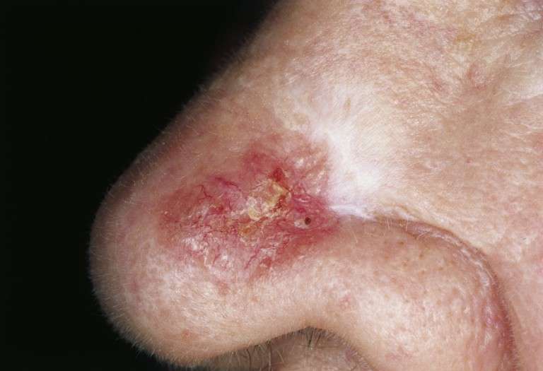 narizcarcinomabasocelular Clínica Dermatológica Novaderma, dermatólogo en