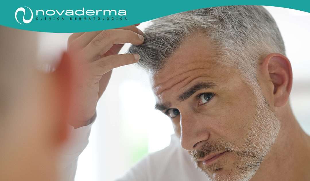 Alopecia; ni un pelo de tonto