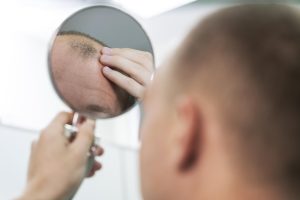 Verdades y mentiras sobre la alopecia