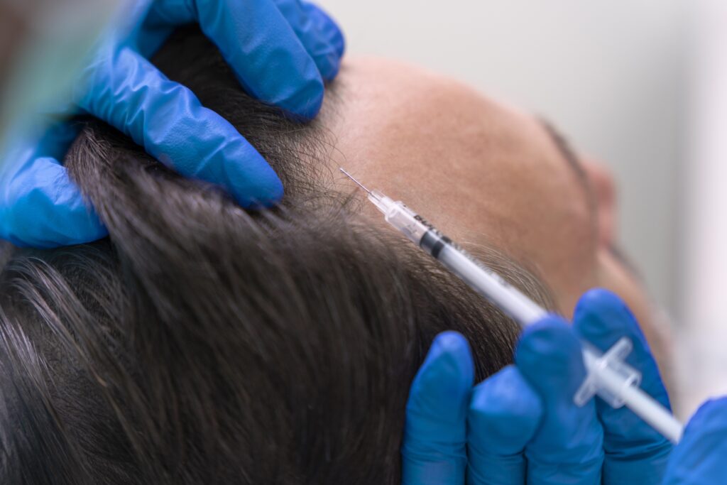 Tratamiento alopecia